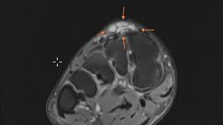 Ganglion cyst or synovial cyst of the foot [upl. by Mulligan]