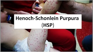 HenochSchonlein Purpura HSP [upl. by Agueda74]