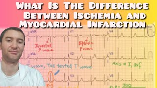 Myocardial Infarction vs Ischemia Whats the Difference [upl. by Fawna]