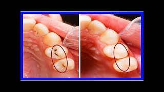 Voici enfin comment remplir les cavités des dents sans l’intervention du dentiste…Incroyable mai [upl. by Austin59]