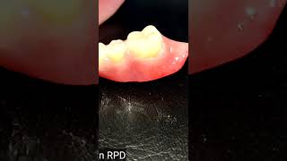 Prosthodontics insertion acetal rpd [upl. by Leugim]