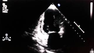 Echocardiogram  akinesia of the inferior wall [upl. by Eyram]