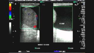 Ultrasound video Hydrocele and epididymal cyst [upl. by Avid321]