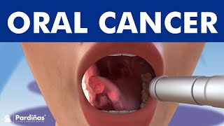 ORAL CANCER and tumors in the mouth lips and tongue © [upl. by Oel]