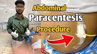 How I do abdominal paracentesis easily during internship after passing FMGE  Abdominal Tap [upl. by Okiron407]