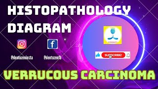 Histopathology diagram of Verrucous Carcinoma [upl. by Aurel135]