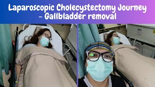 LAPAROSCOPIC CHOLECYSTECTOMY  Gallbladder removal surgery [upl. by Filemon512]