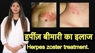 Herpes zoster Shingles treatment in Hindi  हर्पीज़ का इलाज [upl. by Hewes]