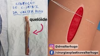 CIRURGIA CORREÇÃO DE CICATRIZ QUELÓIDE Antes Depois  Dr Valter [upl. by Blane]