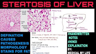 Steatosis Of Liver  Fatty Liver  Pathology [upl. by Rawna592]