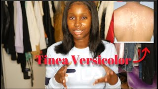 ITS NOT ECZEMA Treating my Tinea Versicolor  Black Skin Friendly [upl. by Ahseel]