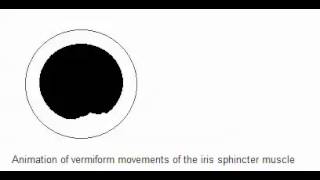 Vermiform movement of the iris spincter muscle  Adies Pupil [upl. by Arawaj]