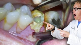 Badly Infected Tooth Extraction Procedure With Pus Coming Out of The Tooth [upl. by Arretnahs]