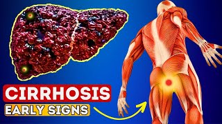 12 Early Signs of Liver CIRRHOSIS  LIVER is DYING [upl. by Karisa]