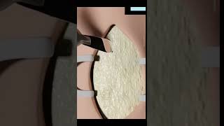 Tracheostomy procedure explained facts 3danimationfact funfacts [upl. by Geithner]