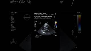 A 69YearOld Man with Dyspnea after Old Myocardial Infarction  NEJM [upl. by Lukash]