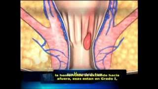 Tratamiento Cura y Remedio Para Las Hemorroides [upl. by Most469]