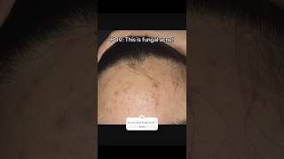 Fungal acne symptoms and treatment shortsfungalacneacne [upl. by Ahsilram]