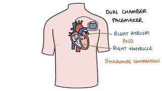 Understanding Pacemakers [upl. by Nnaeerb]