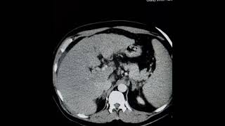 HCC with tumor thrombus extending into LHVIVCLT atrium intrahepatic branches of PV and PV itself [upl. by Penoyer]