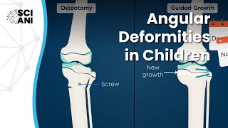 Bow legs and knock knees in children when and how to correct them [upl. by Gahl560]