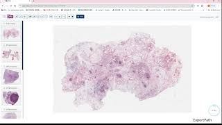 inflammatory myofibroblastic tumorIMT desmoid fibromatosis GIPATH [upl. by Kearney]