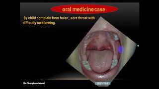 herpangina oral medicine طريقة التشخيص والعلاج [upl. by Ocsisnarf196]