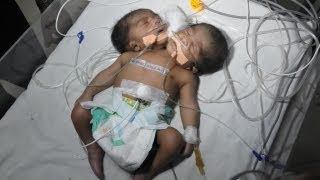 Two Headed Baby Conjoined Twin Boys In India [upl. by Publea620]