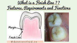 Finish lines in Fixed Partial Denture Finish Lines in Tooth preparation Functions and Requirements [upl. by Hairim]