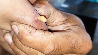 ❌️ COMO REMOVER BERNE DO BRAÇO DIREITO larva na mosca [upl. by Montford]