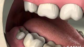 Oral Conditions Periconronitis [upl. by London261]