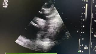 Severe aortic stenosis in case of Neonate￼ [upl. by Ragland]