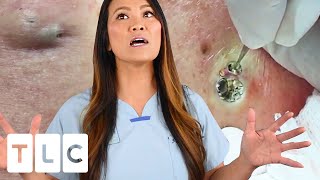 quotThe Award For The Biggest Blackheadquot amp A Juicy Cyst  Dr Pimple Popper This is Zit [upl. by Enyamart]