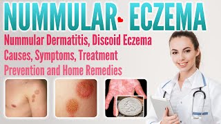 Nummular eczema causes symptoms treatment prevention and home remedies  Discoid Dermatitis [upl. by Aifoz]