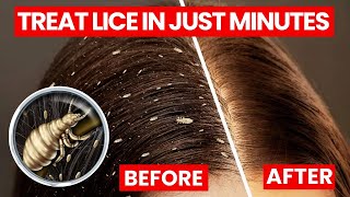 4 Effective Ways to Treat Lice Without Chemicals [upl. by Nell]