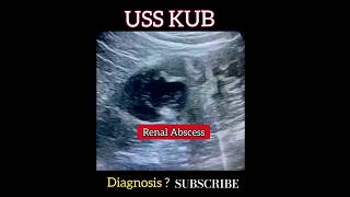 Renal Abscess  Ultrasound scan  Radiology  Short [upl. by Nachison511]