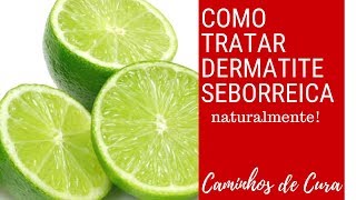 Como Tratar Dermatite Seborreica Naturalmente [upl. by Seaden305]