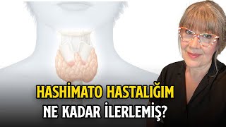 Hashimato Hastalığım Ne Kadar İlerlemiş  Prof Dr Yeşim Erbil [upl. by Atires]