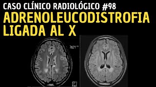 Caso clínico 98 Adrenoleucodistrofia ligada al X [upl. by Rogerson]