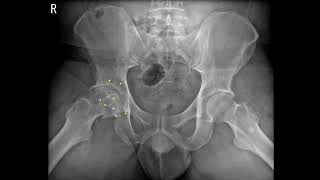 Hip osteoarthritis due to femoral head osteonecrosis [upl. by Attehcram]