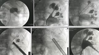 PCNL of staghorn renal stone [upl. by Mitran428]