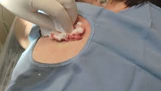 Abscess Opening and Drainage [upl. by Ainslie]