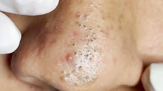 Suri Job 595 Awesome Popping Big Blackheads on Nose [upl. by Venn322]