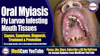 Oral Myiasis Infesting Mouth Tissues  Causes Symptoms Diagnosis and Treatment  Medicam YouTube [upl. by Annmaria]