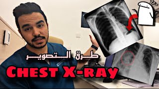 شرح كامل لوضعيات Chest Xray 🫁 [upl. by Aohk581]