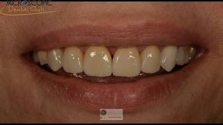 Laminate veneers from preparation to cementation [upl. by Weintrob]