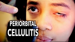 PERIORBITAL CELLULITIS Painful  Dr Paul [upl. by Hailey]