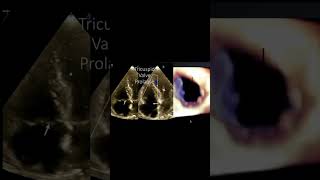 Tricuspid Valve Prolapse [upl. by Inoy206]