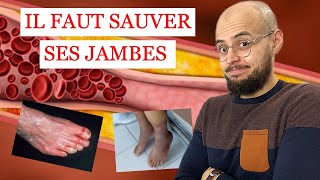 ARTÈRES des jambes BOUCHÉES et ULCÈRE de la PEAU ce quil faut savoir [upl. by Matlick488]