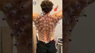 Cupping therapy explained 🫥 [upl. by Iaj]